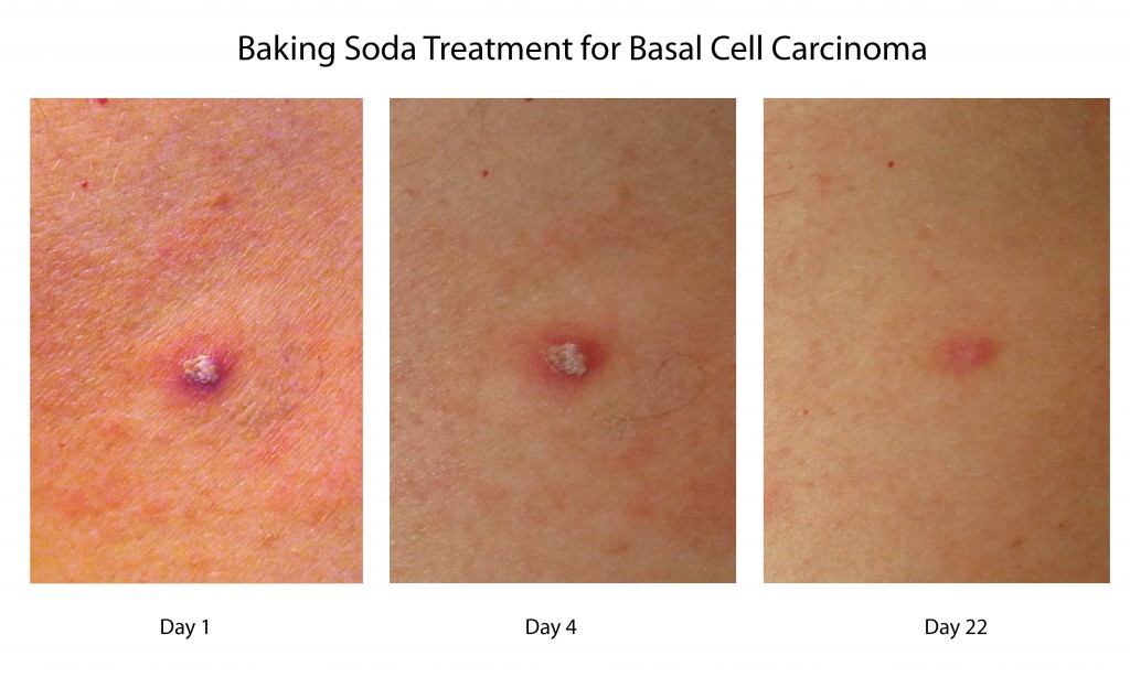 how to use baking soda and coconut oil for basal cell carcinoma